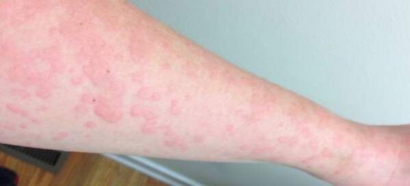 Οι δερματικές αλλεργίες είναι σημάδι της παρουσίας παρασίτων στο σώμα